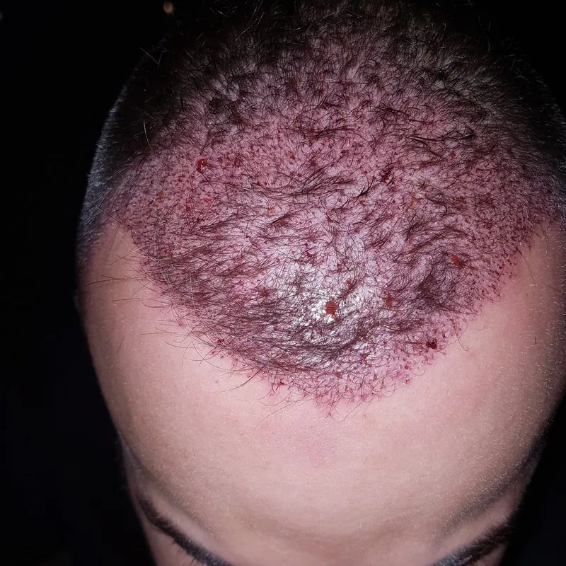 Close view of transplanted grafts and scalp irritation during recovery