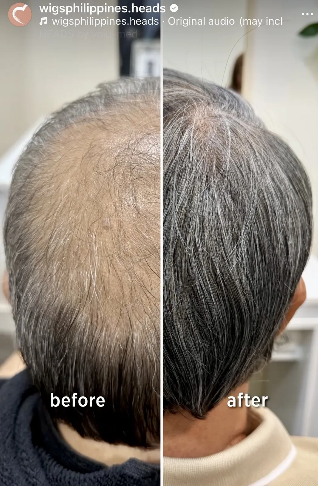 Non-surgical hair replacement before and after — thinning before, full grey hair after
