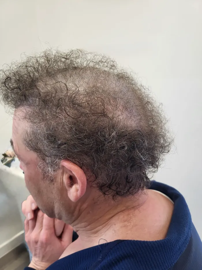 HEADS client before his hair system — thinning crown with grey curly hair, side view