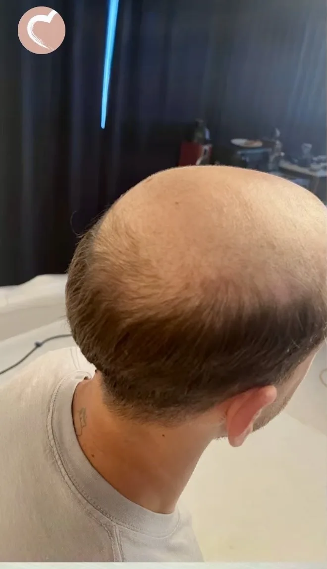 Real HEADS client — bald crown before his hair system, back view